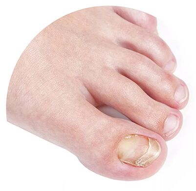 Misserfolgs Niederlage durch einen Pilz verursacht